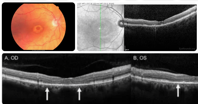 Plaquenil Eye Exam