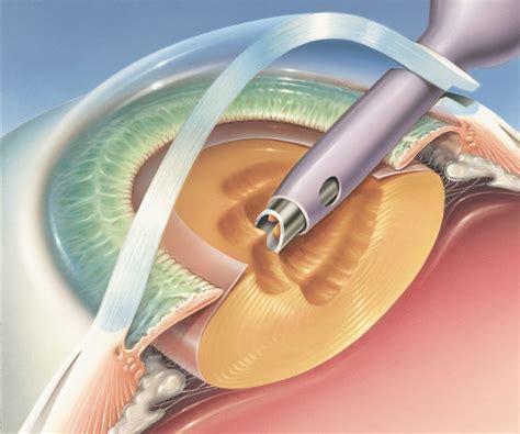 do you need annual eye exams after cataract surgery