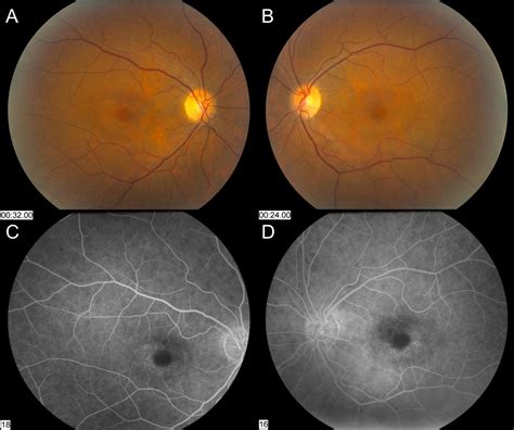 hydroxychloroquine eye exam