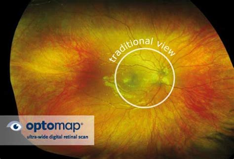 optos eye exam