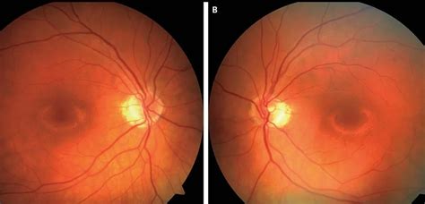 plaquenil and eye exams