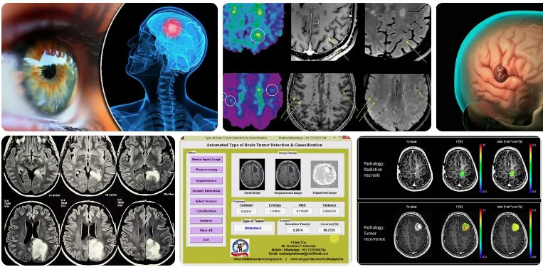 Can an Eye Exam Detect a Brain Tumor