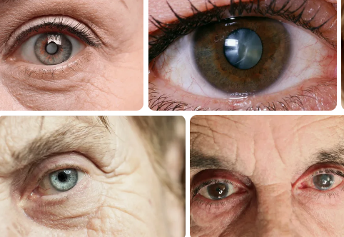 Cataract on Eye Exam