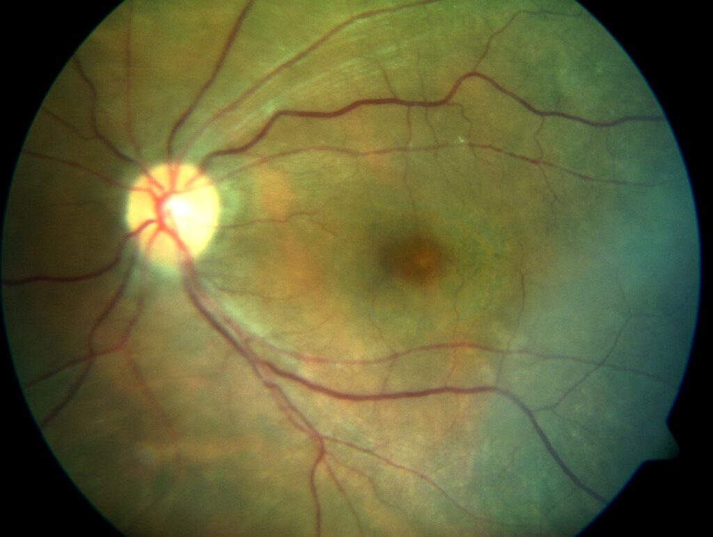 Plaquenil and Eye Exams