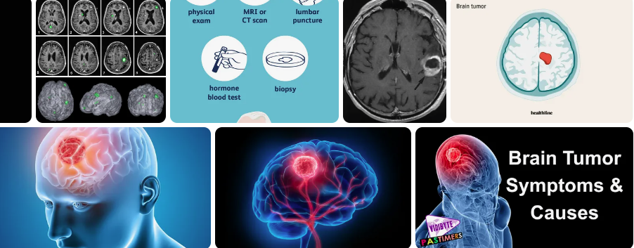 Can Eye Exam Detect Brain Tumor