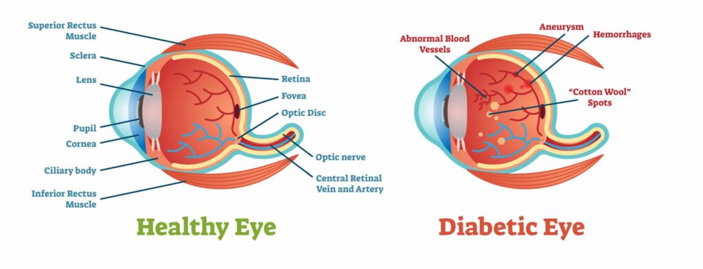 Can Eye Exam Detect Diabetes