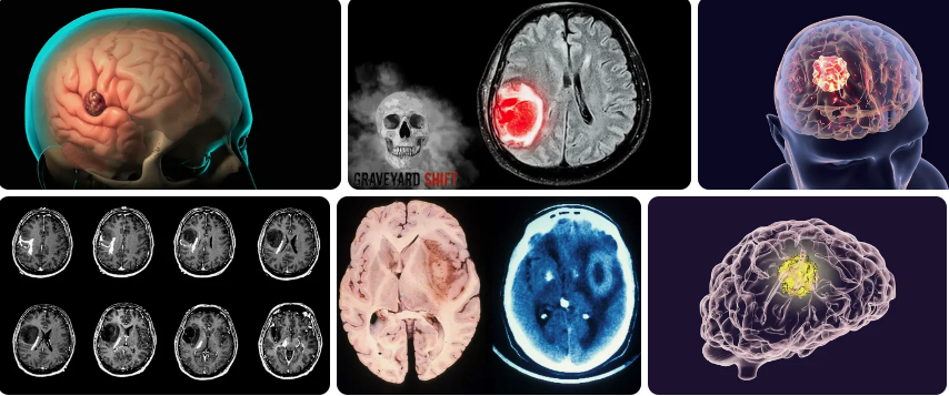 Can a Brain Tumor Be Detected in an Eye Exam